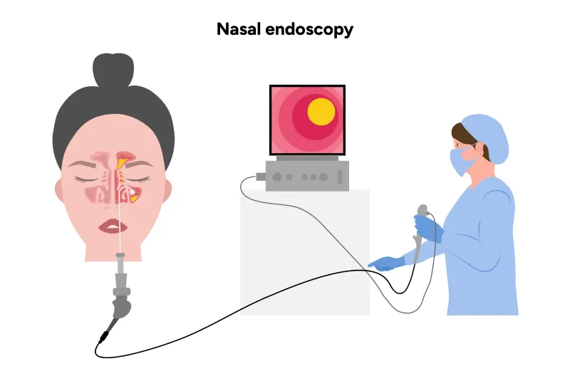 Functional Endoscopic Sinus Surgery (FESS) 