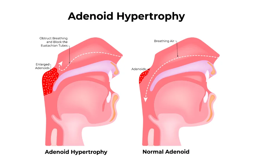 Adenoidectomy