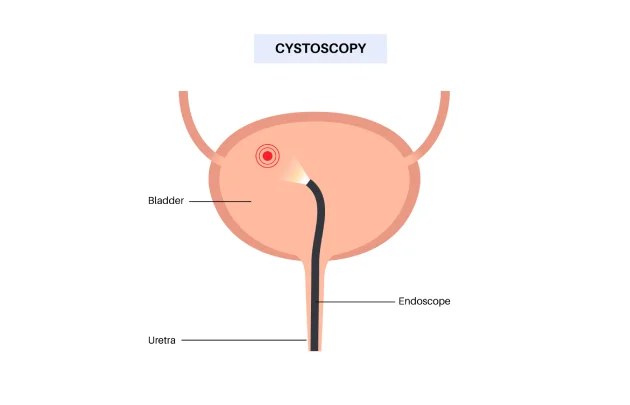 Cystectomy