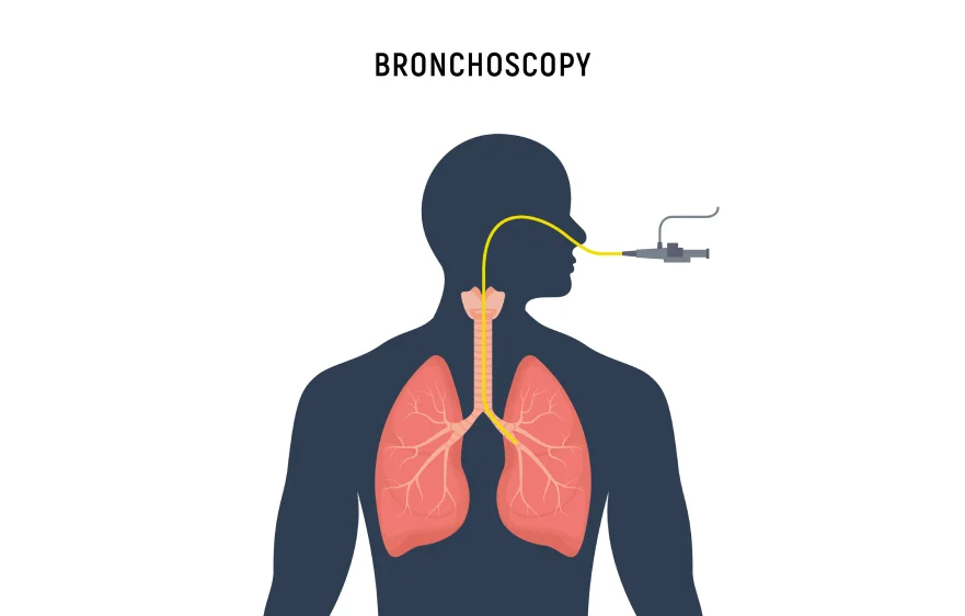Bronchoscopy