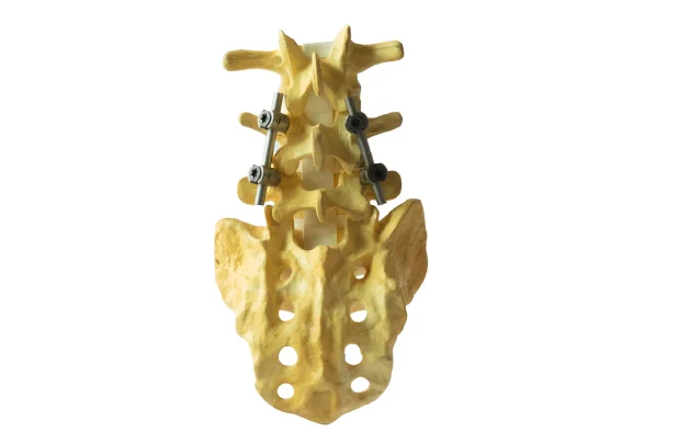 Spinal Fixation Surgery 