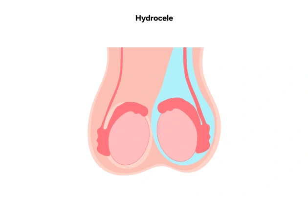 Hydrocele Repair