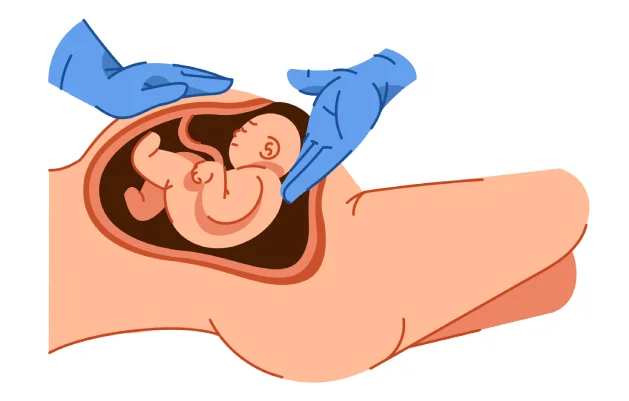 Cesarean delivery 