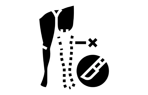 Amputation