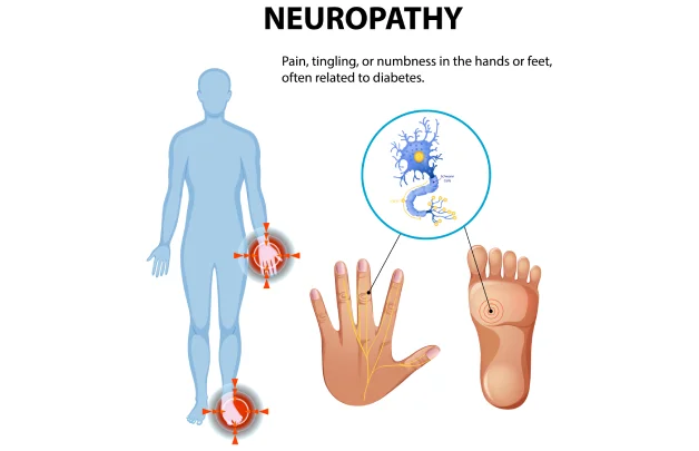 Selective Nerve Root Block (SNRB)