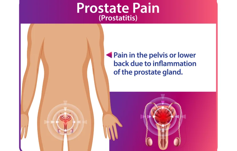 prostatitis-banner2.webp