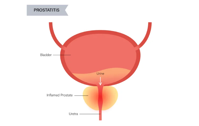prostatitis-banner3.webp