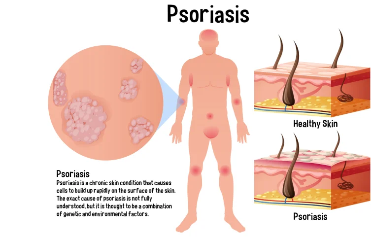 prostatitis-banner4.webp