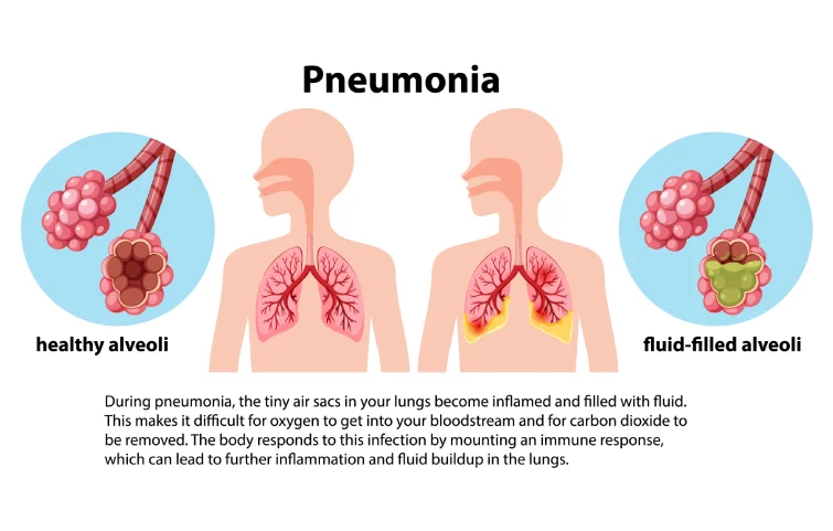 pneumonia-banner.webp