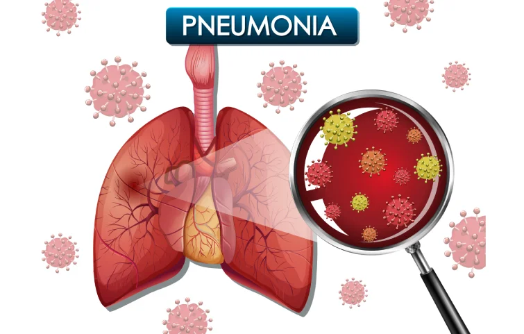 pneumonia-banner2.webp