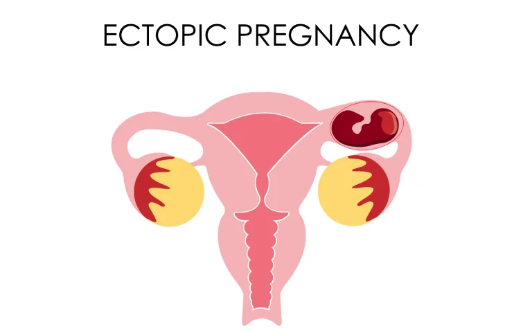 120asi_ectopic-pregbig.webp