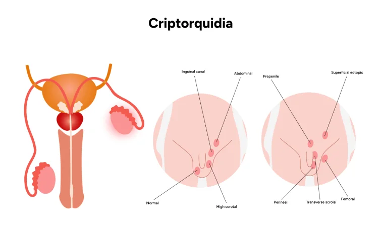 undescended-testicle.webp