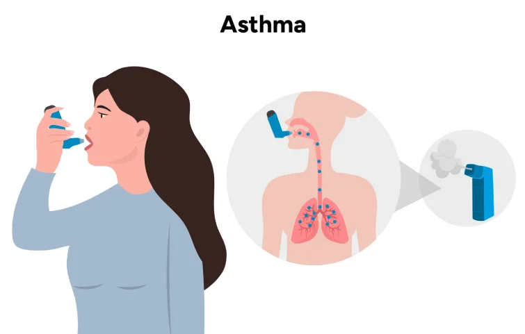 asthma-banner.webp