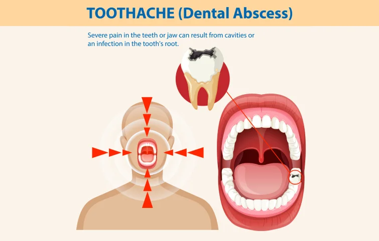 tooth-abscess.webp