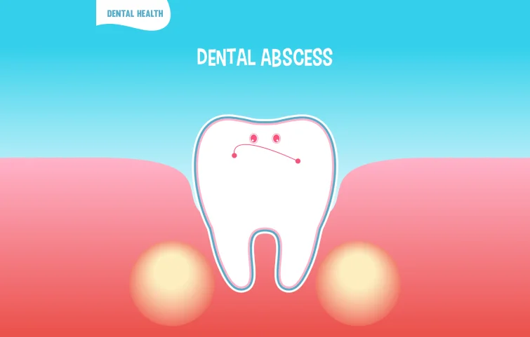 tooth-abscess-banner.webp