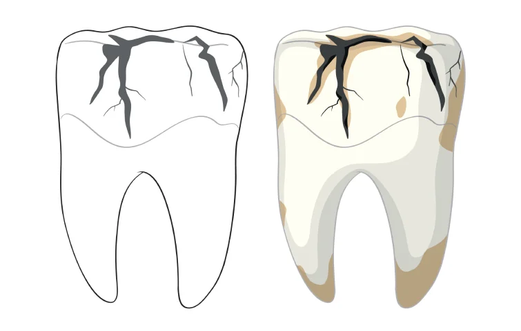 tooth-fracture-banner.webp