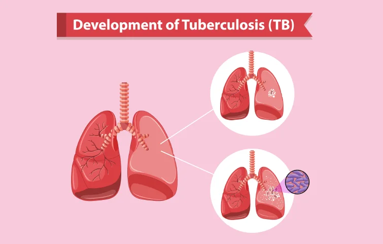 tuberculosis-banner2.webp