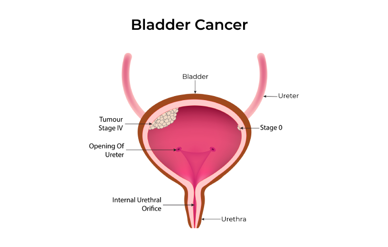 141asi_bladder-cancer-banner.webp