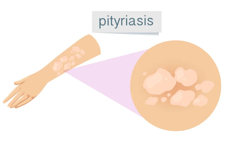 142asi_pityriasis-human-skin-banner.webp