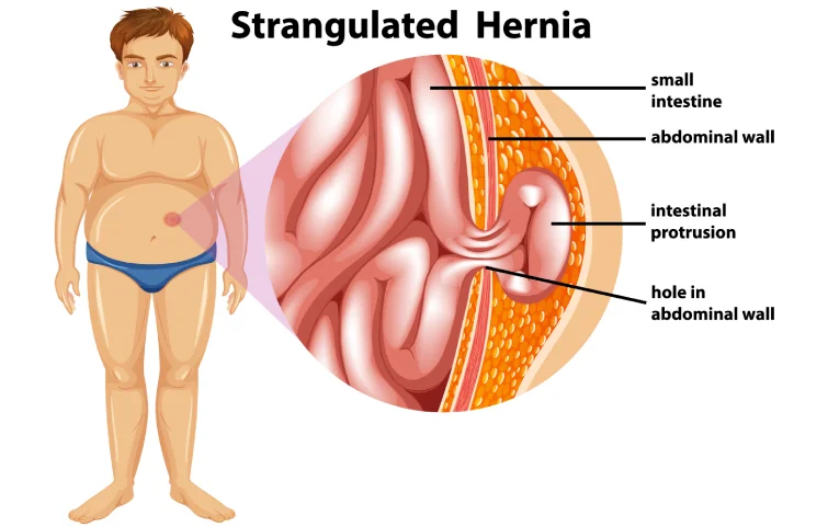 148asi_hernia1.webp
