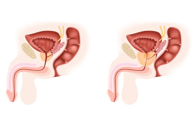 benign-prostatic-hyperplasia (1).webp