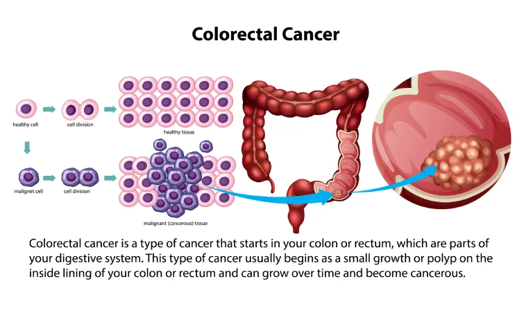 colon-cancer-banner.webp