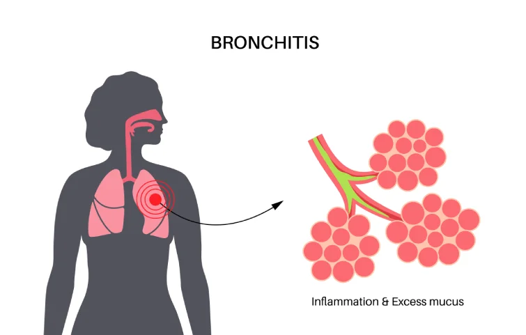 bronchitis-acute-bronchitis.webp