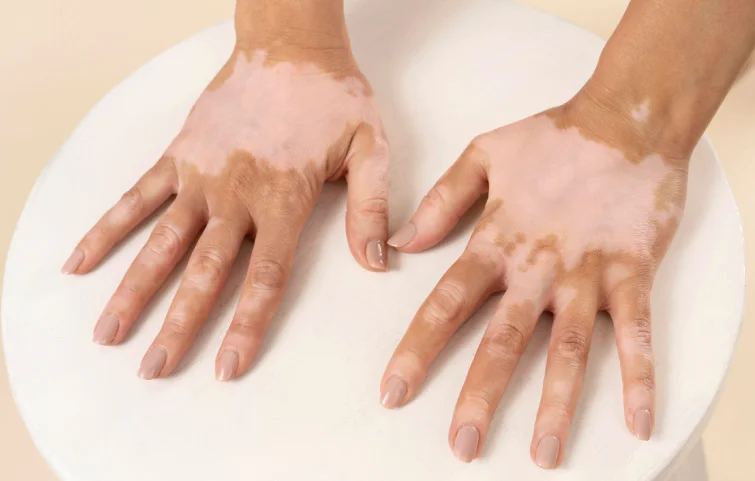 vitiligo-banner.webp