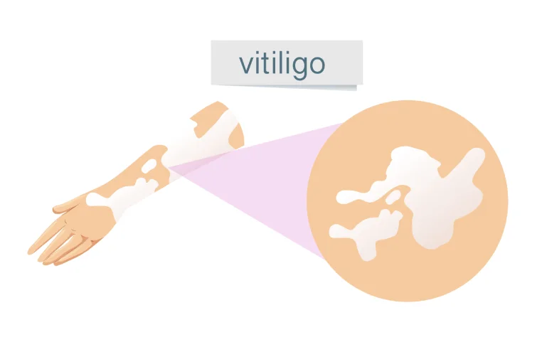 vitiligo-banner3.webp
