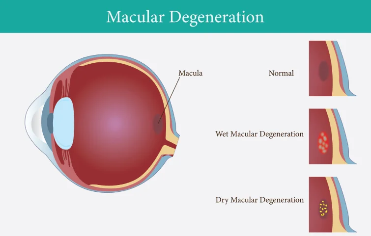 wet-macular-degeneration-banner.webp