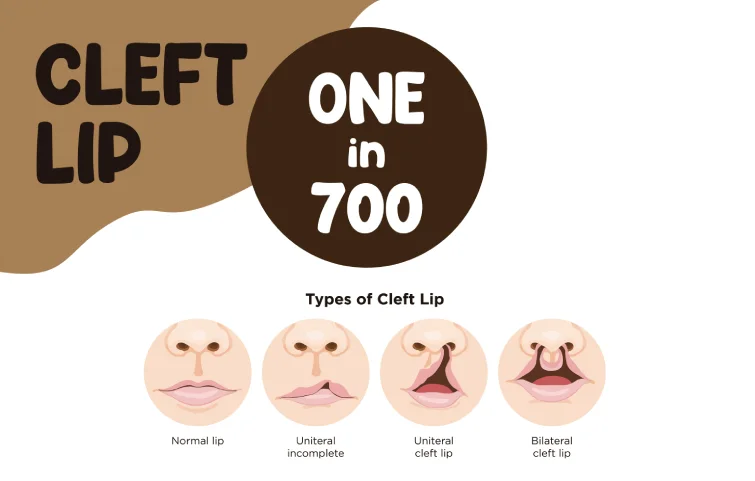 174asi_cleft-lip-banner.webp