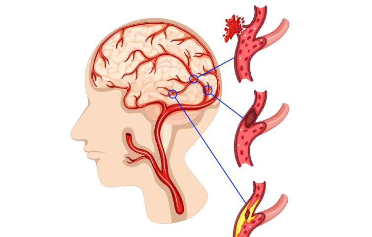 brain-clot-banner.webp