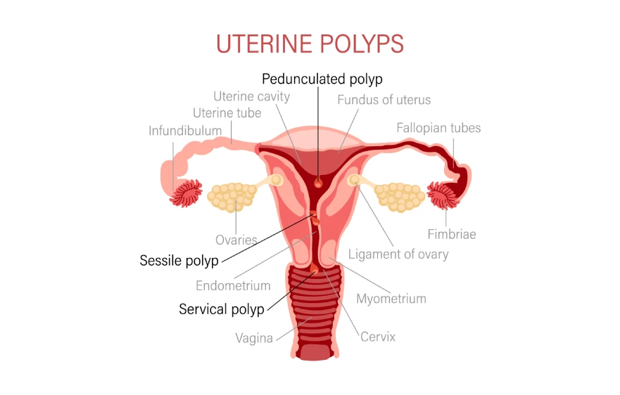 uterine-polyps.webp