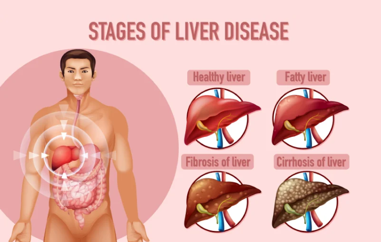 180asi_chronic-liver-disease-banner.webp