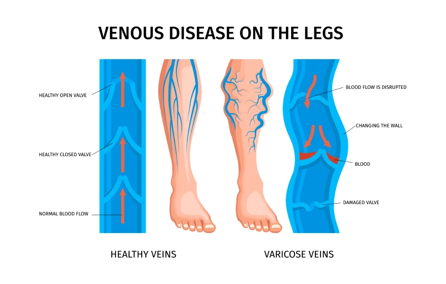 veins (1).webp