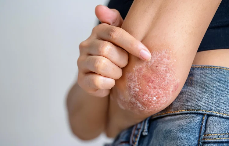 psoriasis-vulgaris1.webp