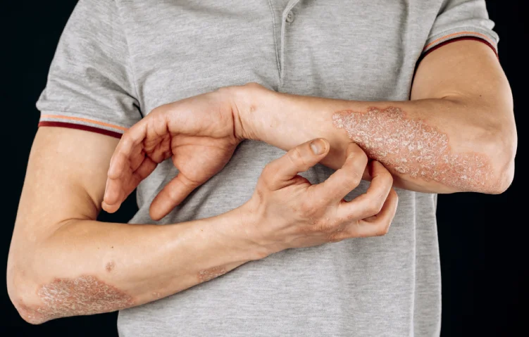 psoriasis-vulgaris2.webp