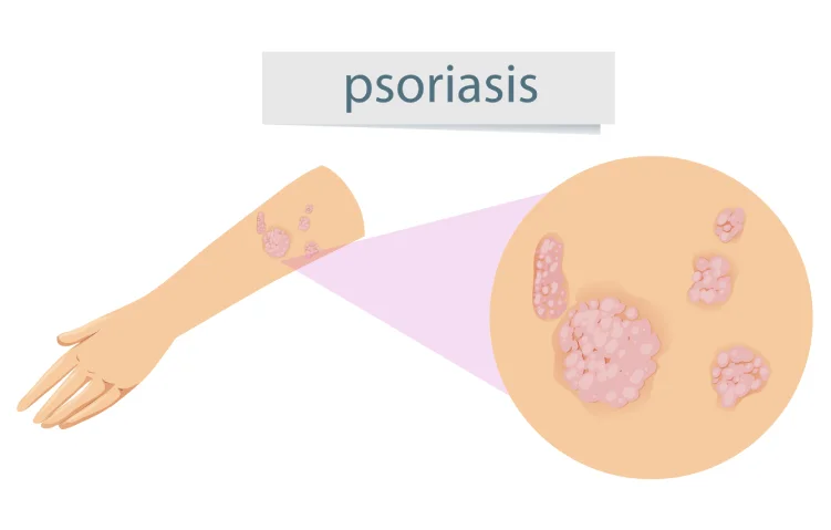 psoriasis-vulgaris3.webp