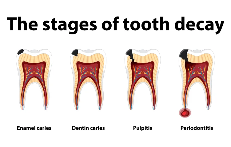 periodontitis1.webp