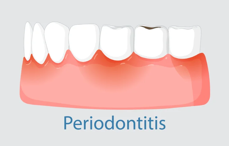 periodontitis2.webp