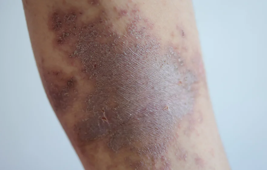 atopic-dermatitis-banner2.webp