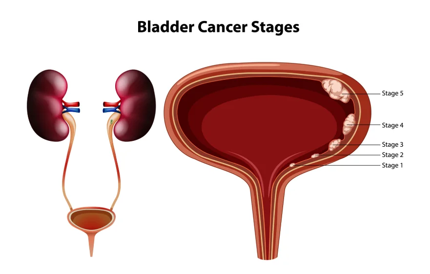 bladder-cancerbanner (1).webp