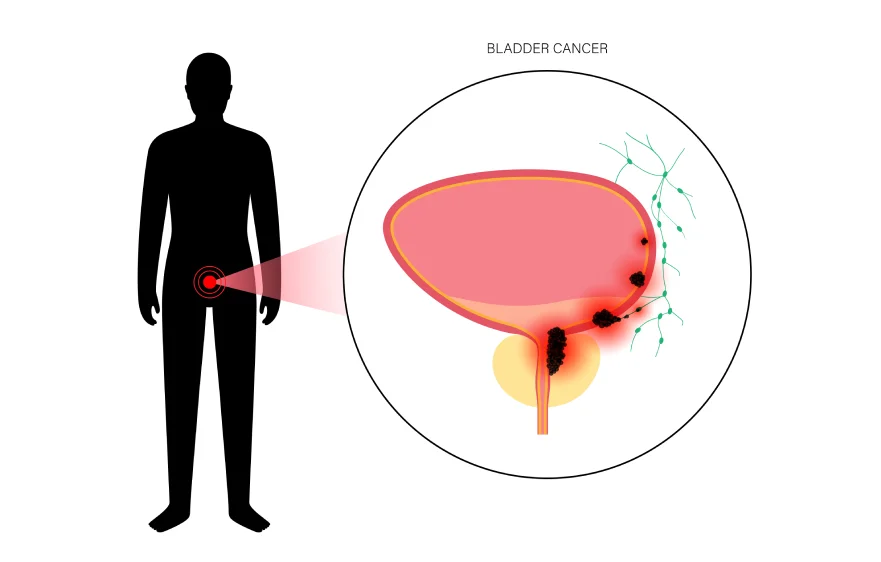 bladder-cancerbanner.webp