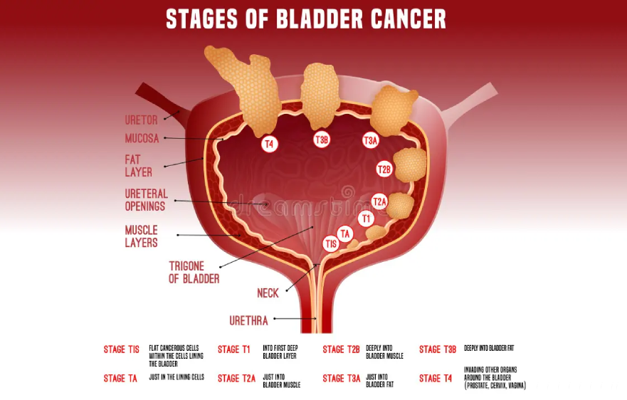 bladder-cancer (1).webp