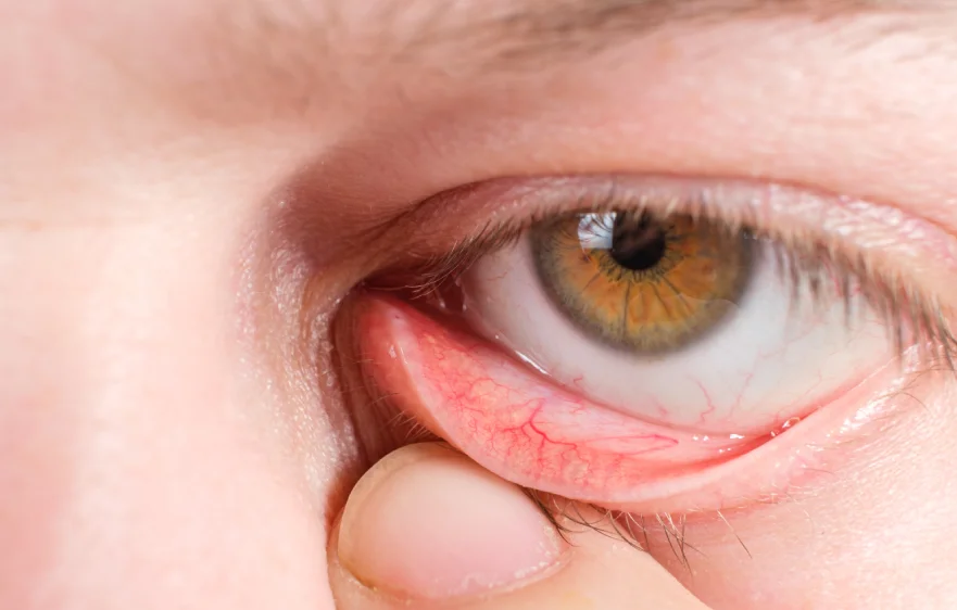 blephatitis-banner (4).webp