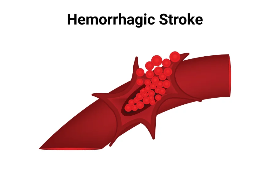 brain-hammriage-banner (1).webp