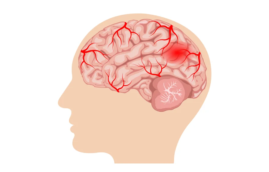 brain-hammriage-banner (2).webp