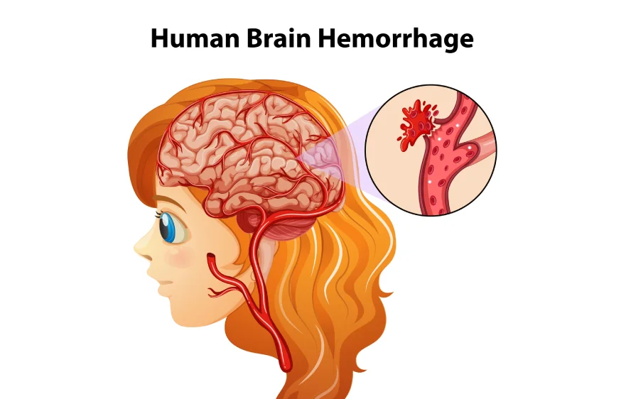 brain-hammriage-banner (3).webp