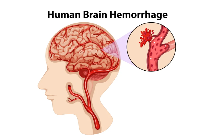 brain-hammriage-banner.webp