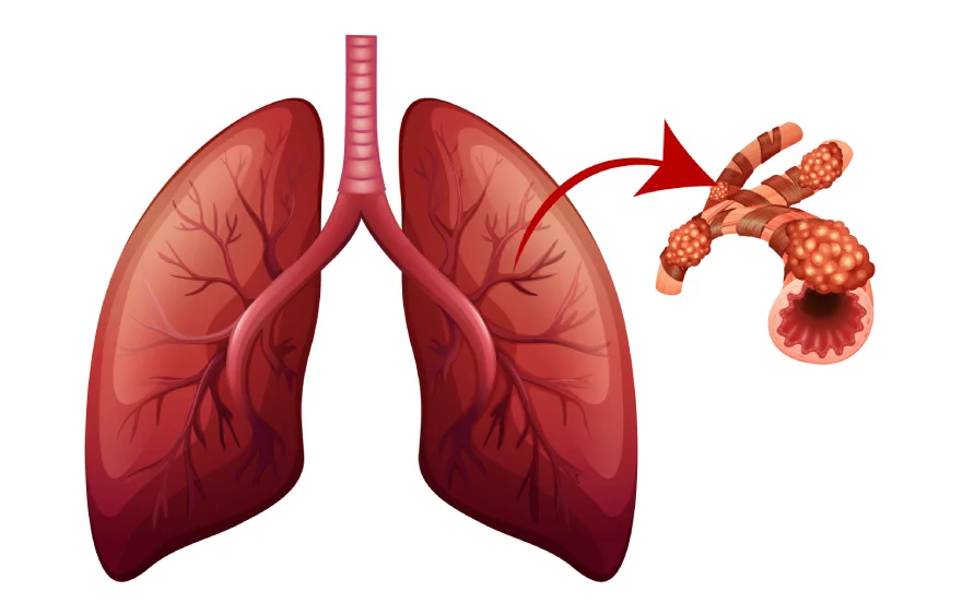 bronchiectasis-banner (1).webp